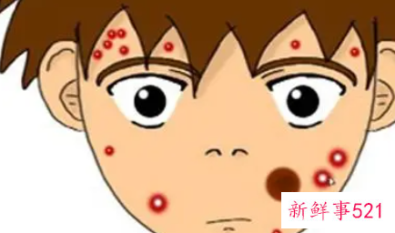 初中生青春痘怎么处理