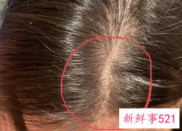 洗完头之后头皮屑特别多怎么办