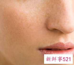 脸上有黑斑怎么办