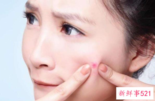 油性皮肤老长痘怎么办