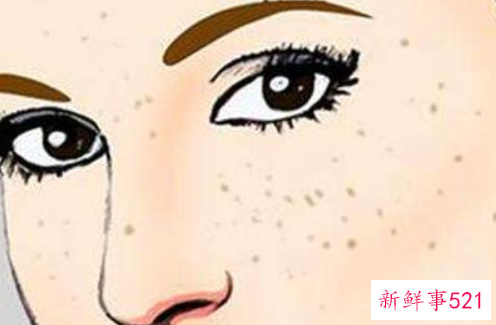 脸上的雀斑是怎么来的