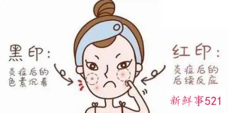 民间祛痘印最快的方法