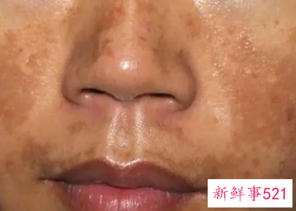 脸上的色素沉着怎样处理