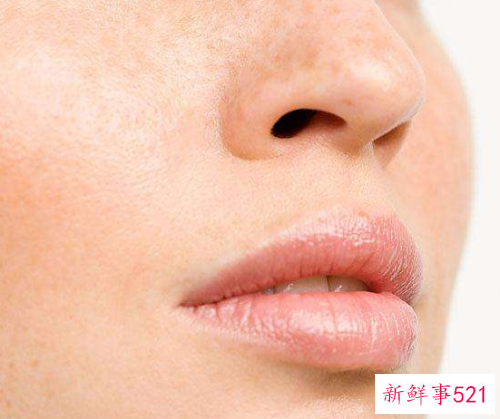 脸上有黑斑怎么办