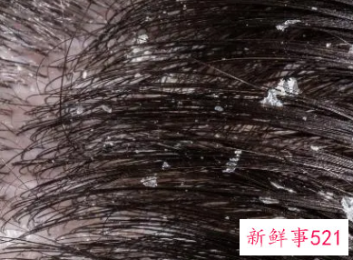 洗完头之后头皮屑特别多怎么办