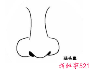 隆鼻手术有后遗症吗