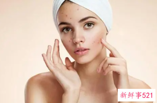 油性皮肤老长痘怎么办