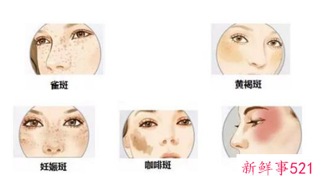色斑是如何形成的