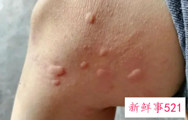 全身皮肤瘙痒警惕9种疾病