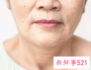 脸上起干纹怎么办