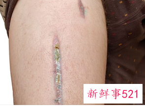 伤口没脓但发白不愈合