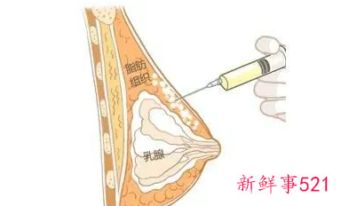 隆胸自体脂肪填充能维持几年