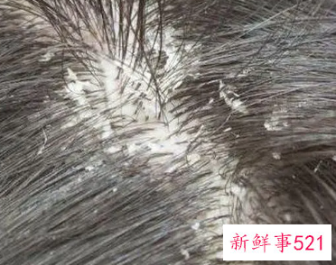 洗完头之后头皮屑特别多怎么办