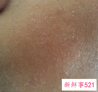 脸上起皮和白色碎屑是什么原因