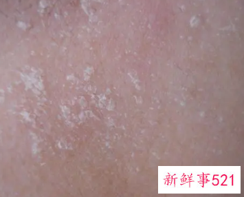 脸上起皮和白色碎屑是什么原因