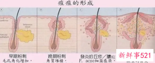 初中生青春痘怎么处理
