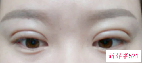 双眼皮怎么快速消肉条