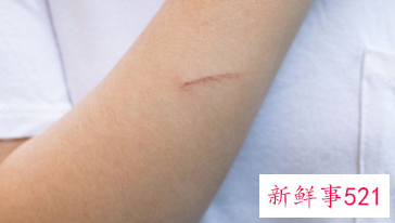 全身痒痒一挠就起疙瘩怎么回事