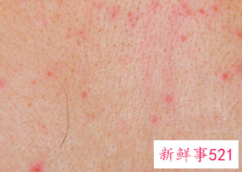 全身痒痒一挠就起疙瘩怎么回事