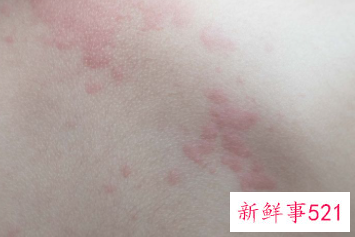 全身皮肤瘙痒警惕9种疾病