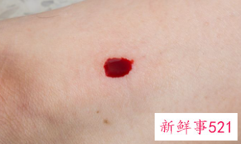 全身痒痒一挠就起疙瘩怎么回事