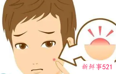 初中生青春痘怎么处理