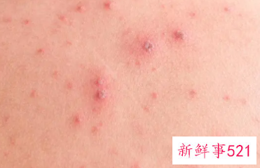 全身皮肤瘙痒警惕9种疾病