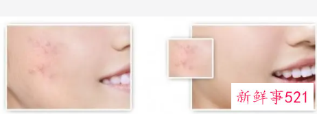 民间祛痘印最快的方法