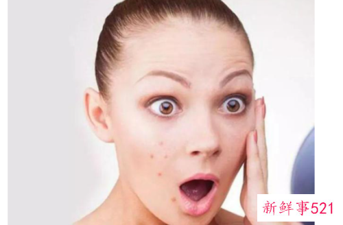 油性皮肤老长痘怎么办