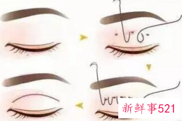 各种脸型适合的双眼皮