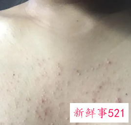 为什么背上和胸前长痘痘