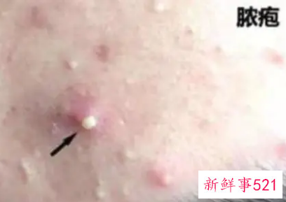 痤疮冒出白尖是好事还是坏事
