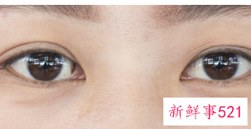 双眼皮眼头宽眼尾窄