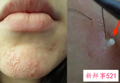 痤疮冒出白尖是好事还是坏事