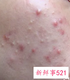 怎么不让脸上长痘痘