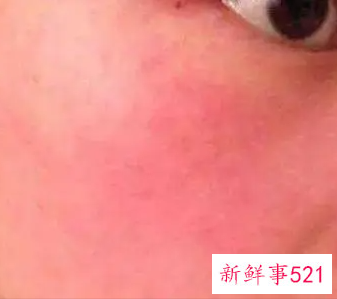皮肤敏感发红发热怎么补救