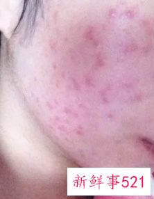 怎么不让脸上长痘痘