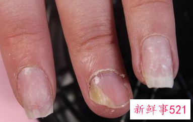 手上真菌感染早期症状