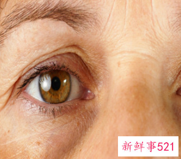 眼睛旁边的脂肪粒怎么去除小妙招