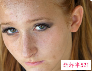 额头长痘怎么去除