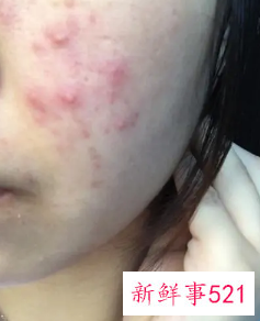 怎么不让脸上长痘痘
