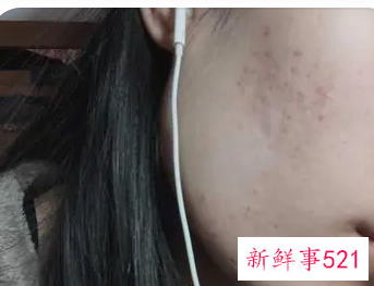 如何淡化黑痘印