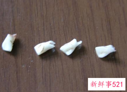 梦见自己牙齿掉了