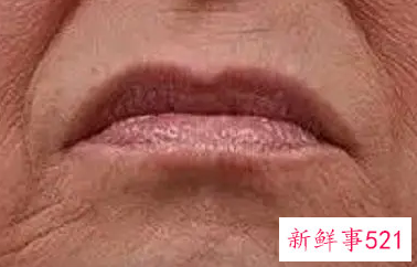 嘴周围的皱纹有什么办法消除