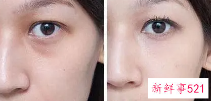 怎么样去眼袋又快又好