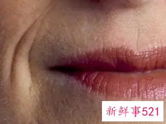 嘴周围的皱纹有什么办法消除