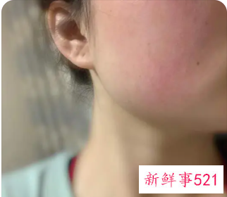 皮肤敏感发红发热怎么补救