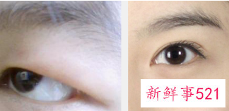 双眼皮眼头宽眼尾窄