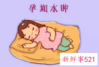 孕妇水肿是什么症状