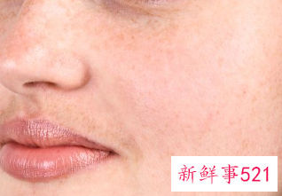 激光祛斑和超皮秒哪个效果好